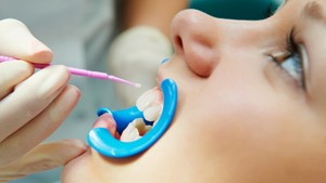 Do Dental Sealants Really Help?