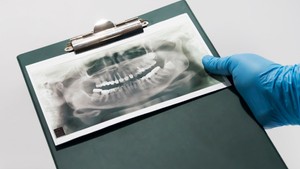 are dental x-rays safe