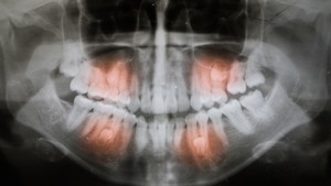 Impacted teeth, impacted molar and impacted canine tooth