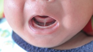 What Is a Light Scalpel Frenectomy?