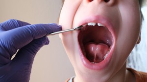 tongue ties