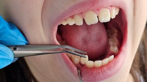 Reasons Your Child May Need a Tooth Extraction