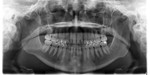 Are Pediatric Dental X-rays Safe?