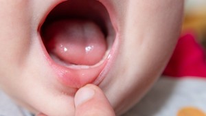 Baby's first tooth and primary teeth eruption